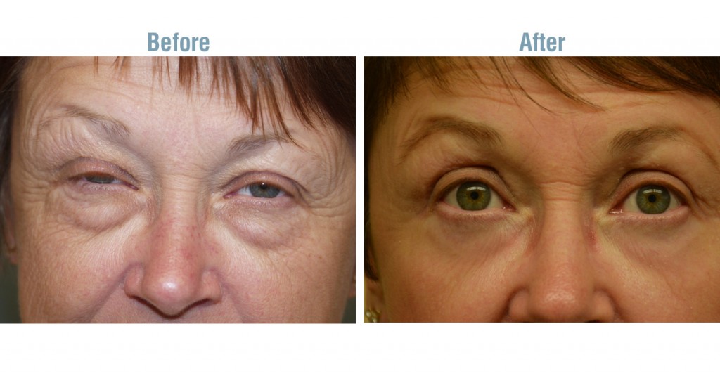 CO2 Laser Blepharoplasty Before After 1