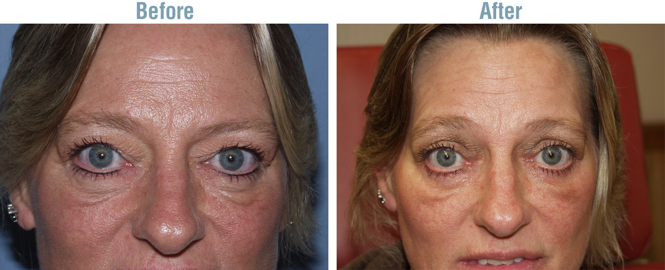 Eye Surgery Before and After