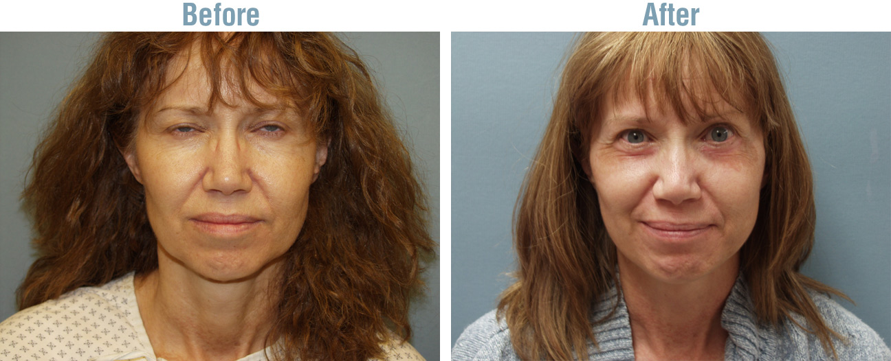 Facelift Surgery Before and After