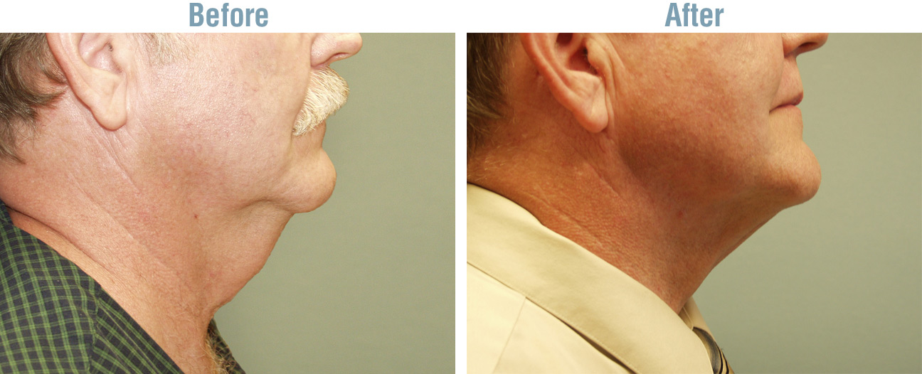 Neck Lift Surgery Before and After