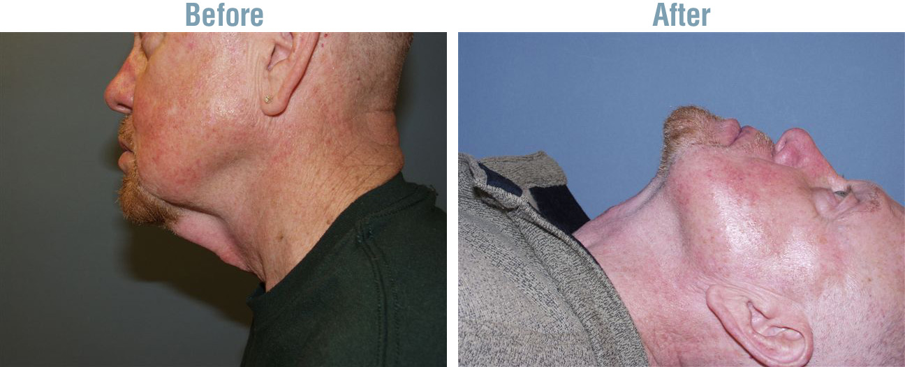 Neck Lift Surgery Before and After