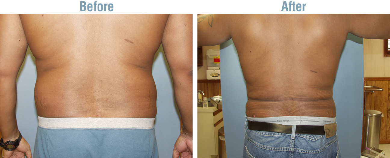Laser Lipo Plus Before and After
