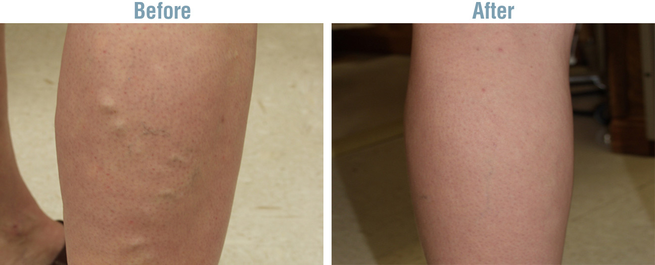 Vein Therapy Before and After