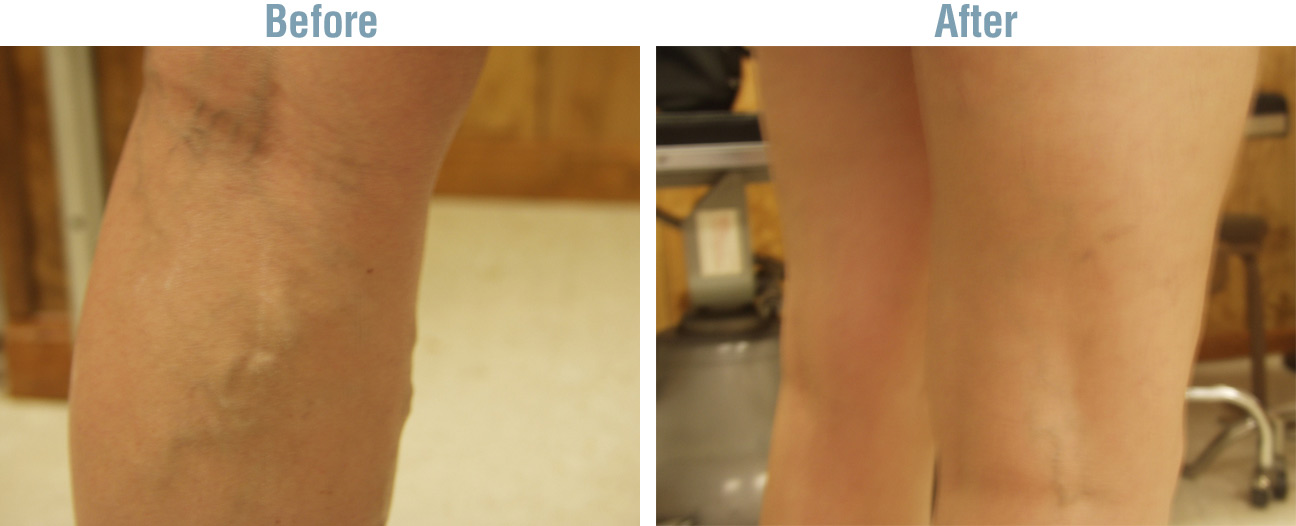 Vein Therapy Before and After
